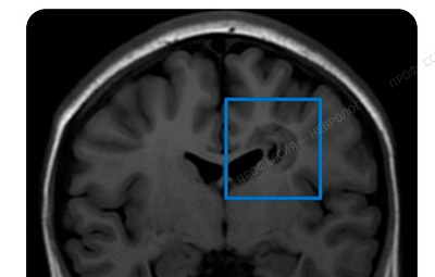 Уникальный случай в Самарской области: правильная интерпретация МРТ помогла впервые диагностировать редкое заболевание у подростка, которое никогда ранее не было зарегистрировано в регионе