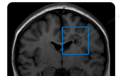 Уникальный случай в Самарской области: правильная интерпретация МРТ помогла впервые диагностировать редкое заболевание у подростка, которое никогда ранее не было зарегистрировано в регионе